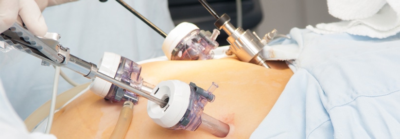 Erleben Sie erstklassige Betreuung in der Magenverkleinerung Türkei Beste klinik